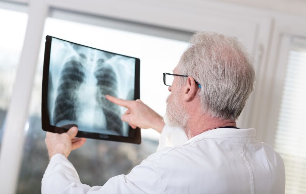 doctor looking at lung x-ray
